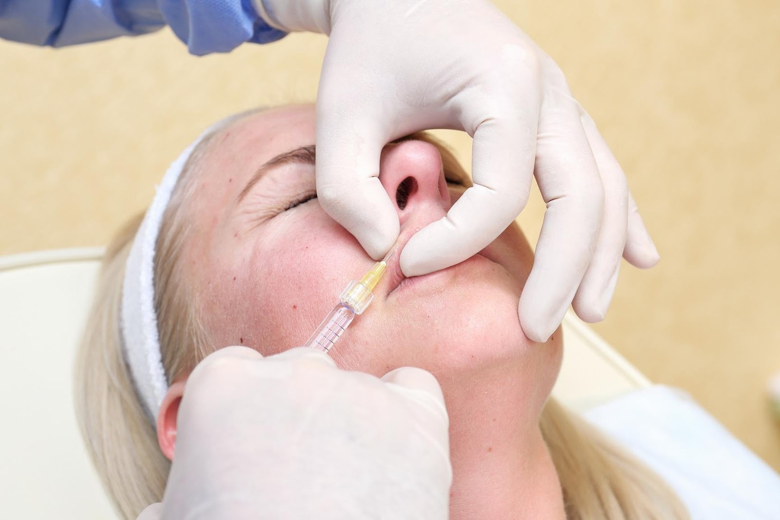 Understanding Lip Filler Migration – Causes, Prevention, and Safe ...