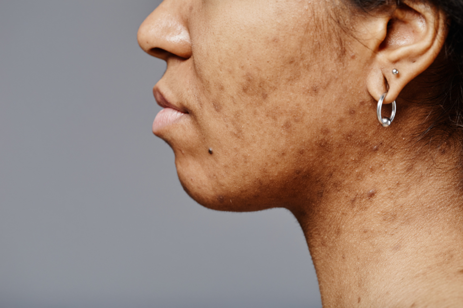 Pigmentation treatment summer Oakville