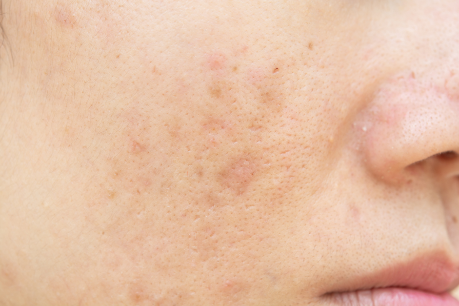Skin confidence after pigmentation treatment Oakville