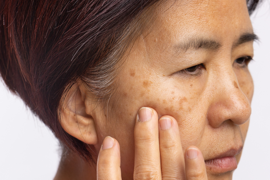 Chemical peels dark spot removal Oakville