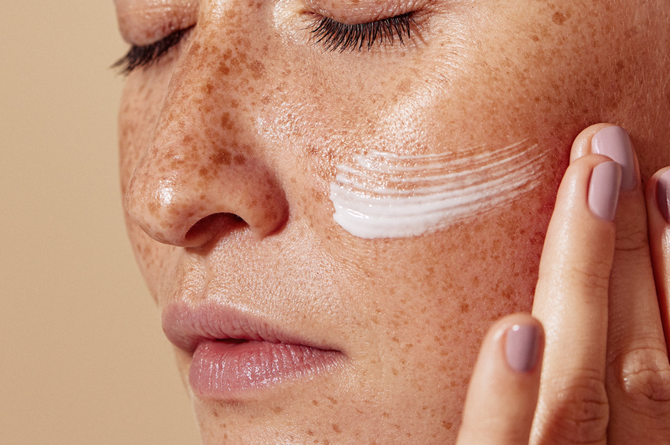 BBL treatment for pigmentation Oakville
